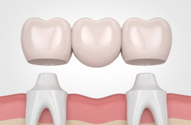 punti si coroane dentare