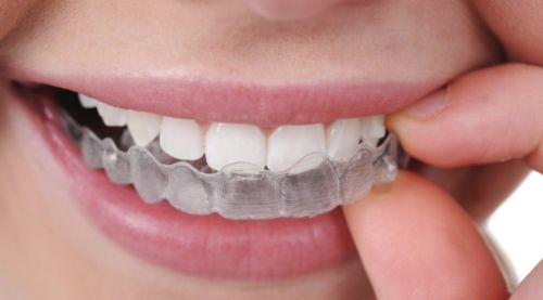 Gutiera-bruxism-arad