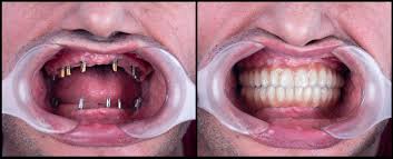 implant dentar