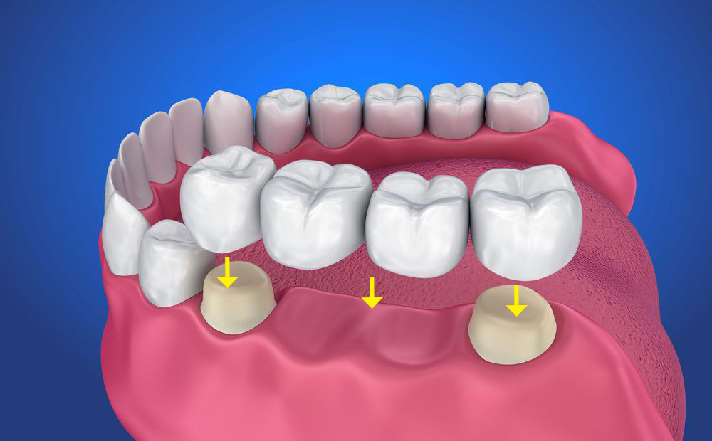 coroane dentare